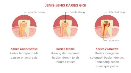 Karies gigi dan Pencegahannya